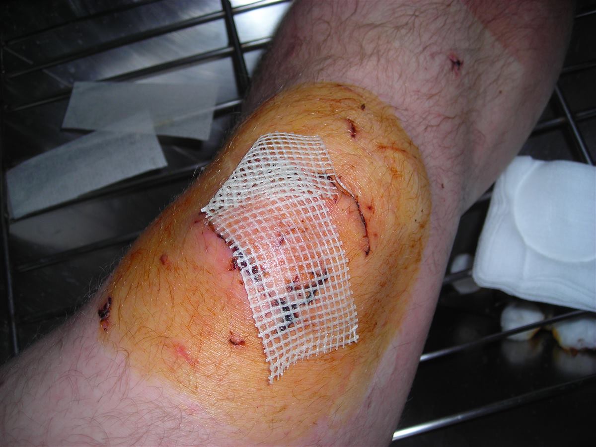 Sterile gauze dressing applied to a wound